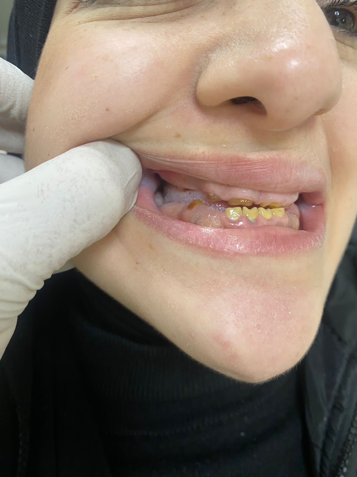 Periodontitis case before treatment